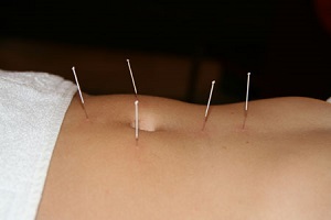 Cos’è e come funziona l’Agopuntura