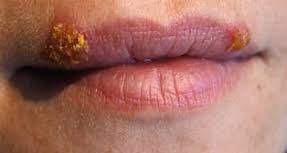 herpes problema